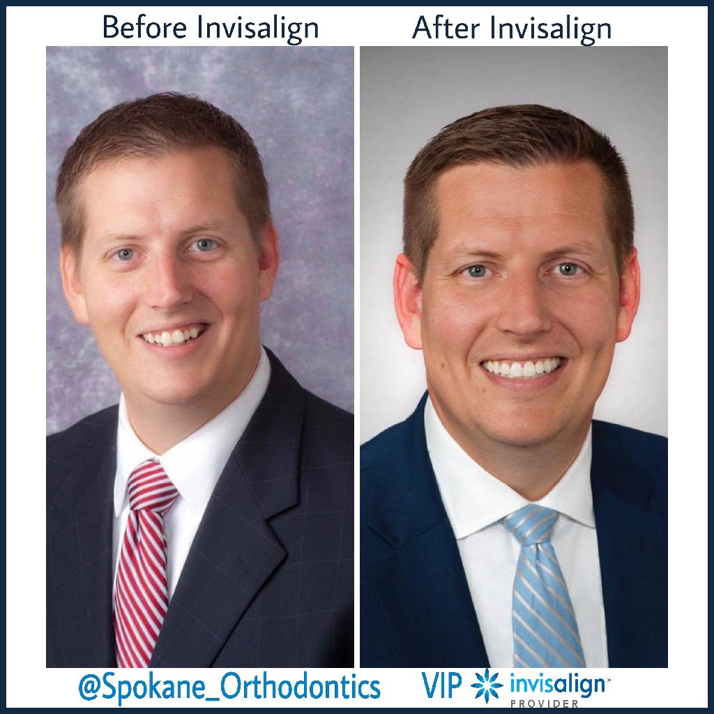 Before and After Invisalign